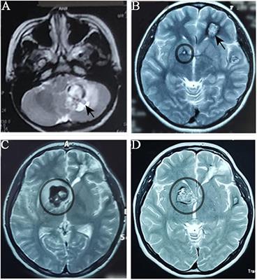 Identification of a Novel CCM1 Frameshift Mutation in a Chinese Han Family With Multiple Cerebral Cavernous Malformations